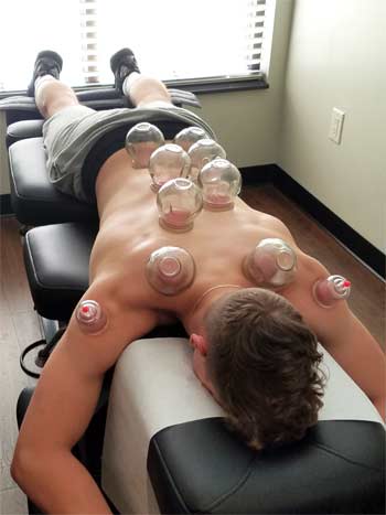 Beavercreek Chiropractic now offer Cupping services