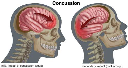 Concussion Illustration