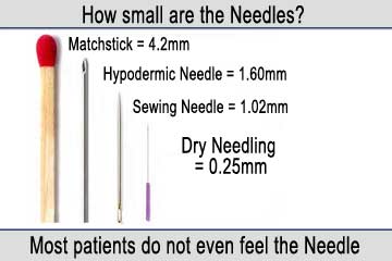 Dry Needling Sizes