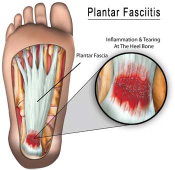 Cupping is the #1 treatment for Plantar Fasciitis