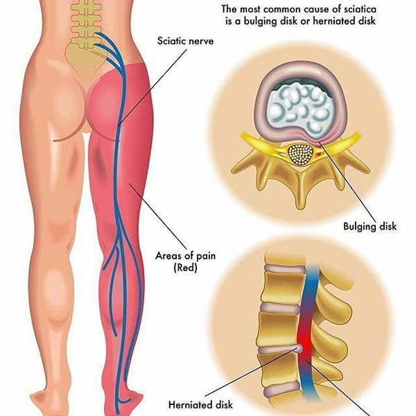 AM&WC offers a variety of treatment options for Sciatica